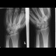 Fracture of navicular bone, fracture of first metacarpal bone: X-ray - Plain radiograph